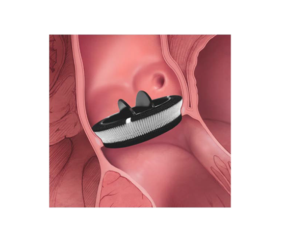 Mechanical Heart Valves - 1