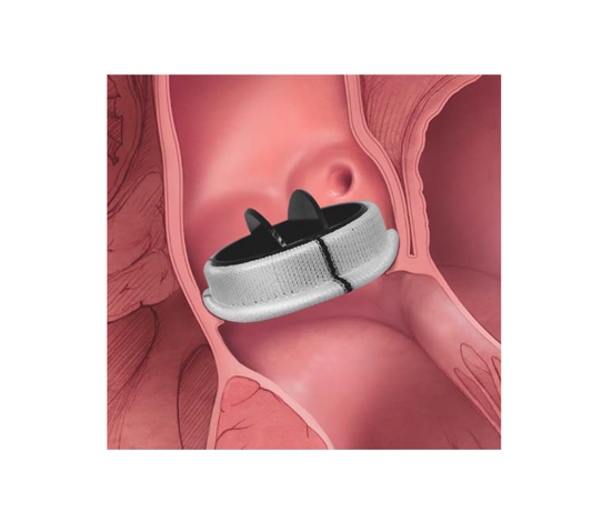 Mechanical Heart Valves - 0