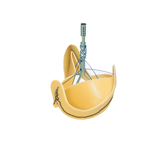 Biological Heart Valves (Bioprosthesis) - 1